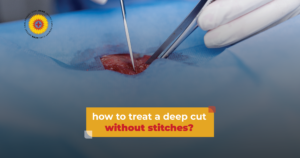 How to Treat a Deep Cut Without Stitches