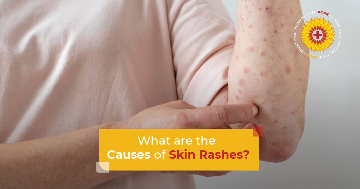 What Are the Causes of Skin Rashes