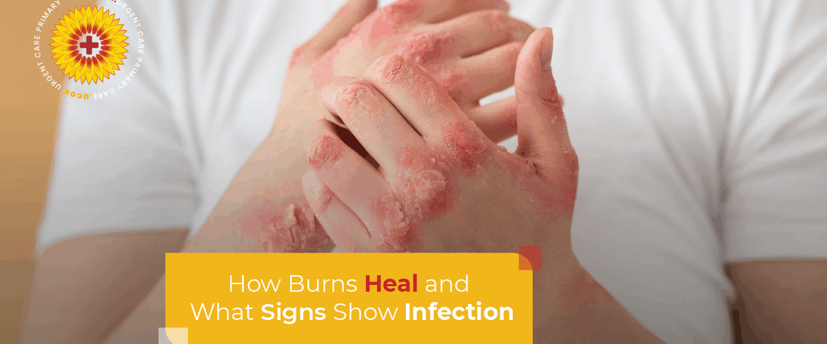 How Burns Heal and What Signs Show Infection