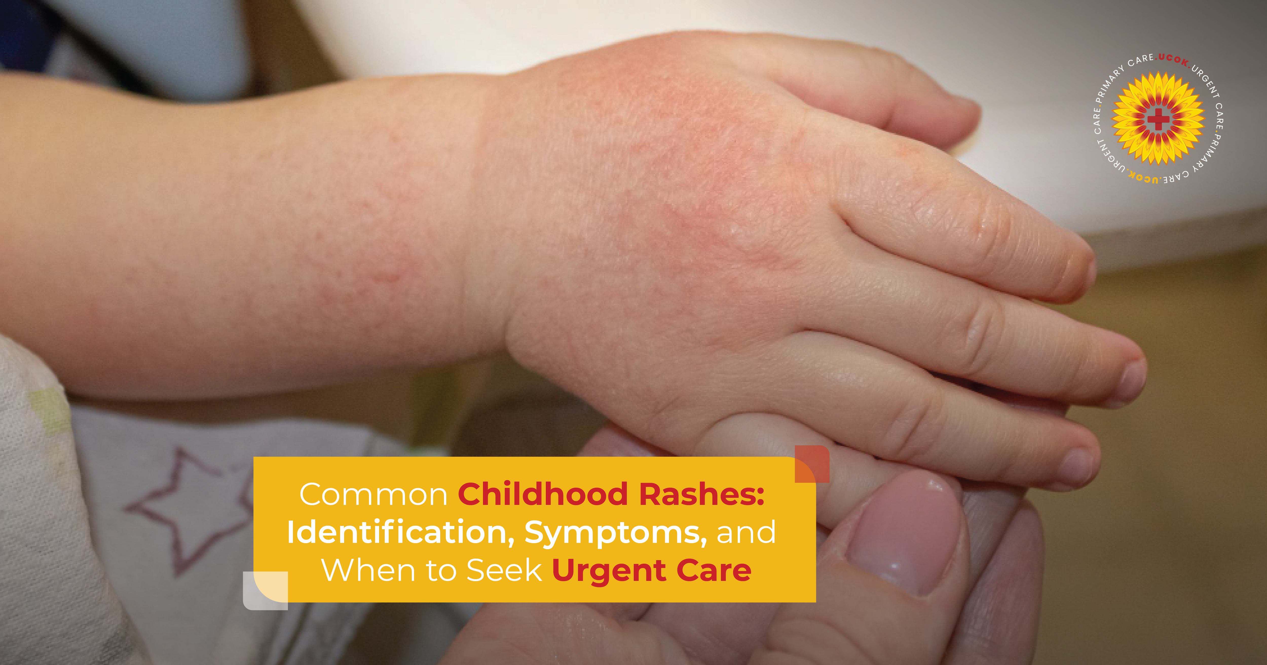 Common Childhood Rashes
