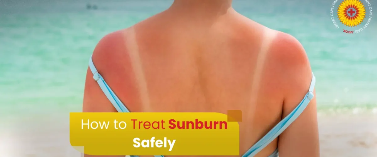 How to Treat Sunburn Safely