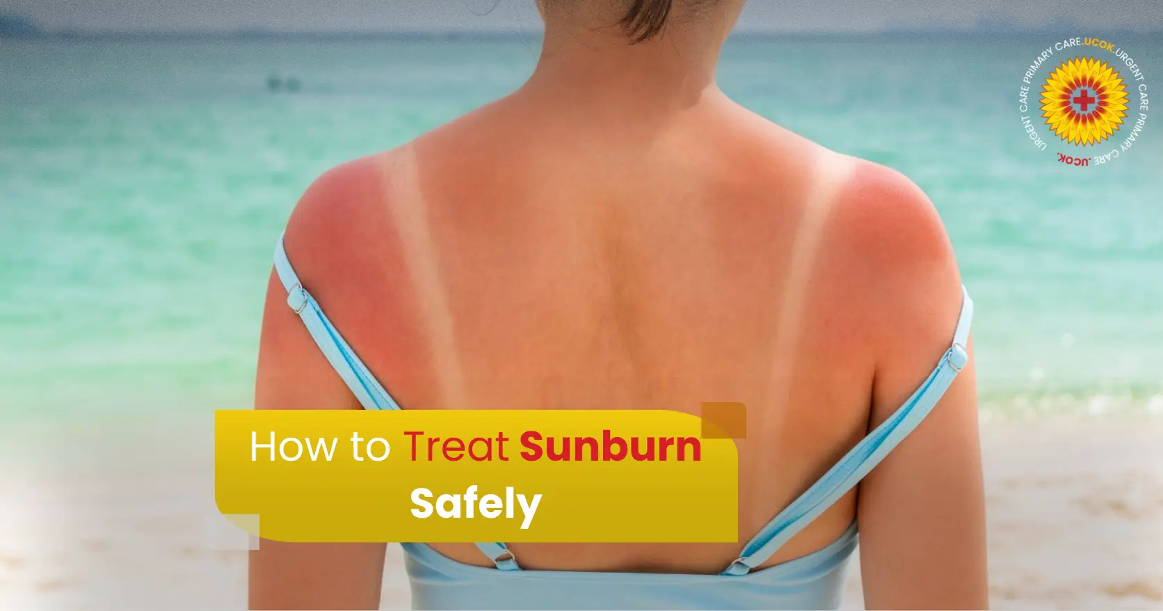 How to Treat Sunburn Safely