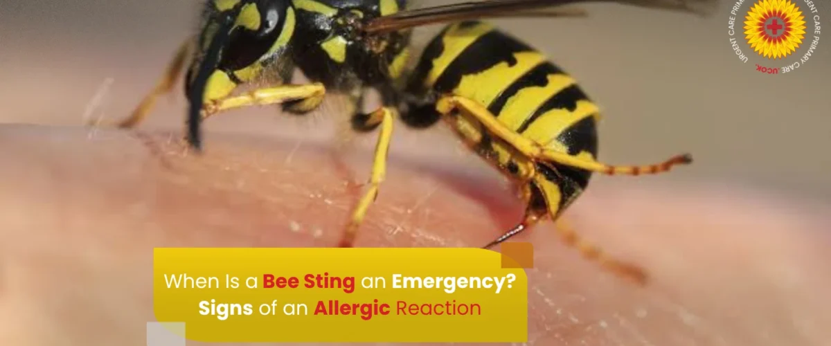 When Is a Bee Sting an Emergency Signs of an Allergic Reaction