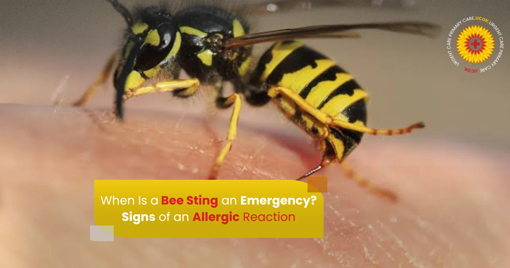 When Is a Bee Sting an Emergency Signs of an Allergic Reaction