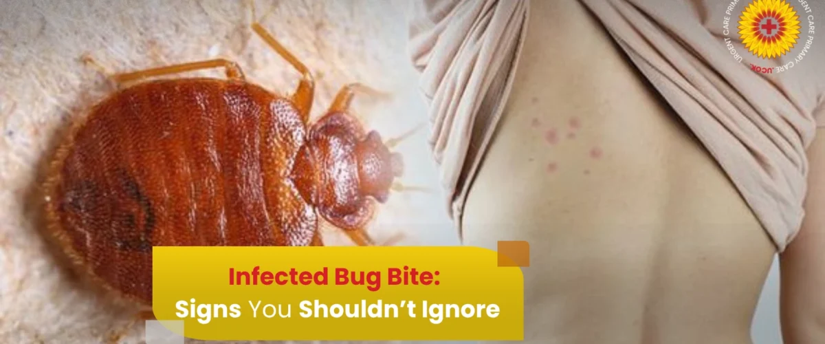 Infected Bug Bite: Signs You Shouldn’t Ignore