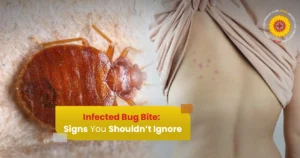 Infected Bug Bite: Signs You Shouldn’t Ignore