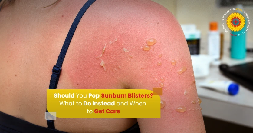 Should You Pop Sunburn Blisters What to Do Instead and When to Get Care
