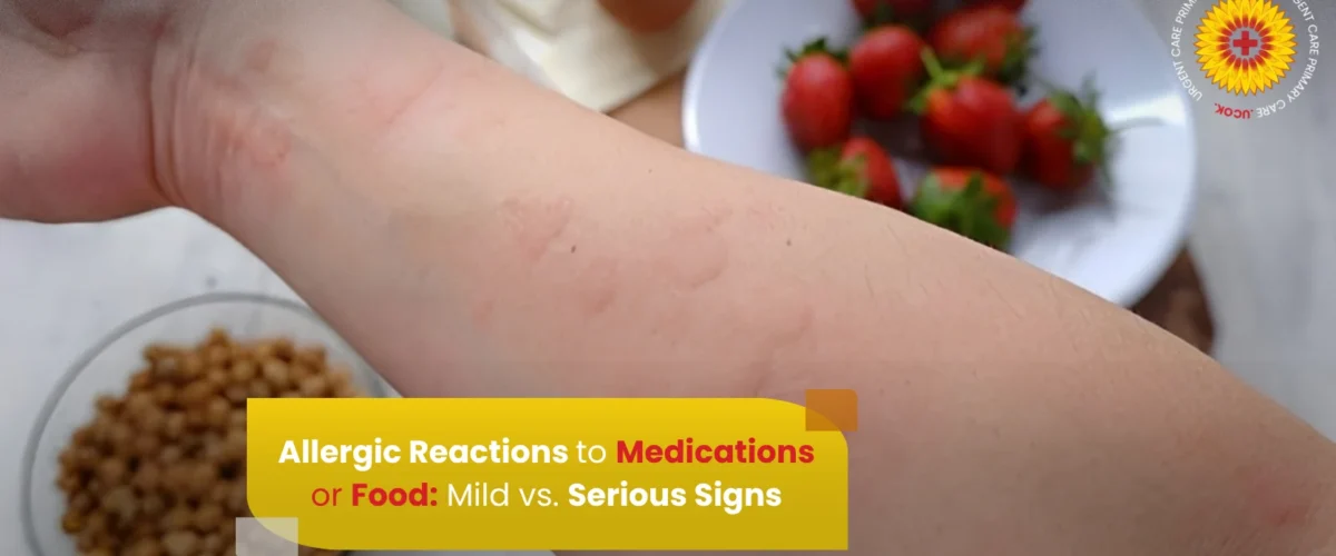 Allergic Reactions to Medications or Food Mild vs  Serious Signs
