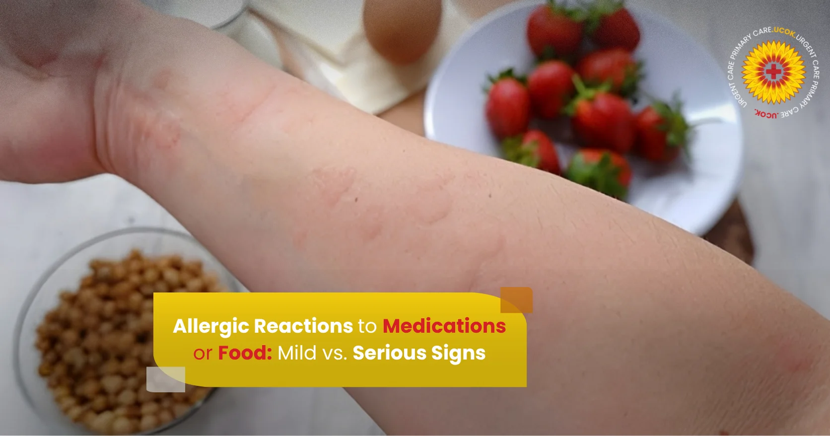 Allergic Reactions to Medications or Food Mild vs Serious Signs